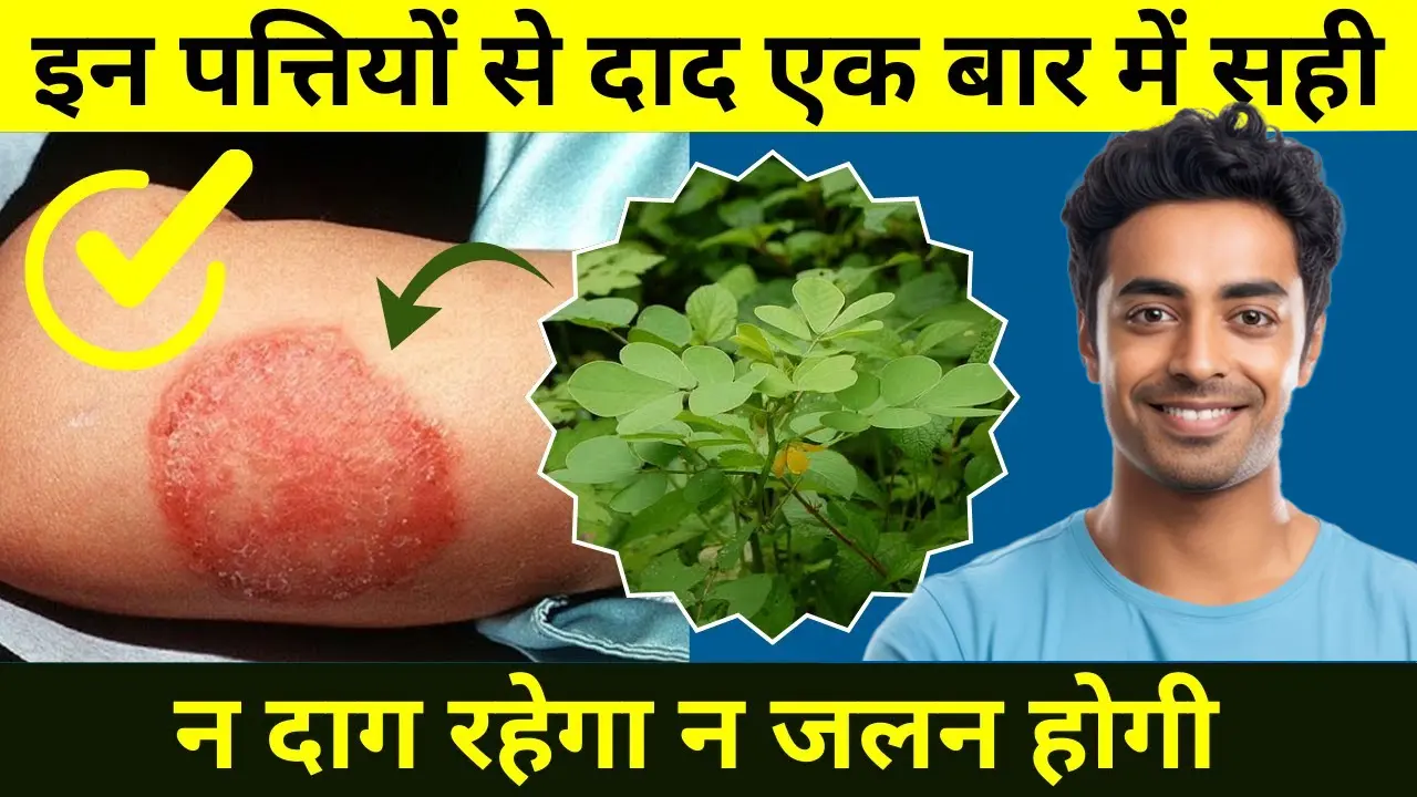 दाद जड़ से खत्म करने का देसी नुस्खा | फंगल इन्फेक्शन का अचूक घरेलू इलाज